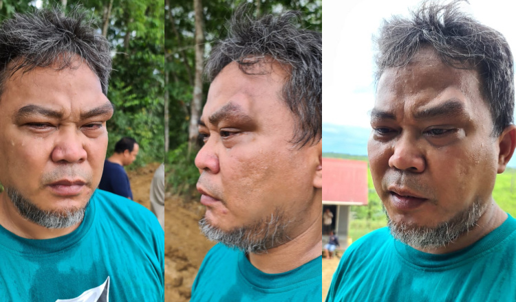 Tampak pelipis mata kiri Arfan Boma, Camat Tenggarong, sekaligus Ketua KKSS Kukar, membengkak setelah dipukul oknum kelompok pekerja tambang ilegal, Minggu (9/5/2021).